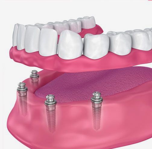 Implant denture